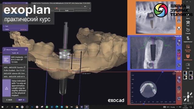 Создание хирургических шаблонов в программе exoplan смотреть онлайн