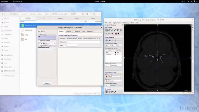 Tips for PhDs and MScs - Visualization: Overlay 3D MRI Images and Segmentation смотреть онлайн