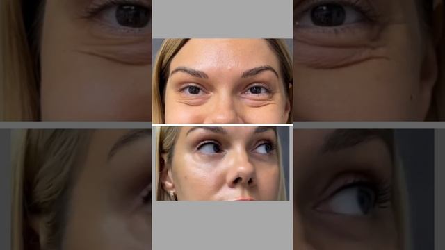 Результат нижней блефаропластики #блефаропластика #подтяжкалица #эндоскопия #нижняяблефаропластика