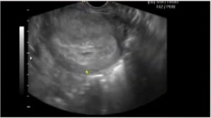 УЗИ на 6 неделе беременности