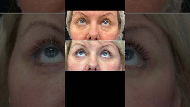 #блефаропластика #пластическийхирургспб #beforeandafter