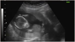 УЗИ на 15 неделе беременности