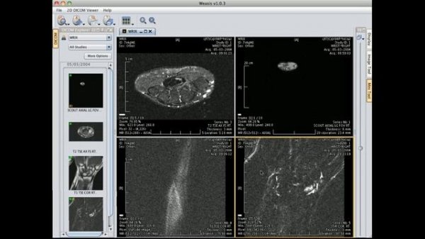 Weasis: a DICOM web viewer - 2 x 2 viewing