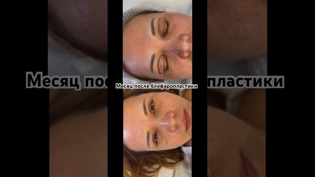 Верхняя блефаропластика #верхняяблефаропластика #пластическийхирургспб