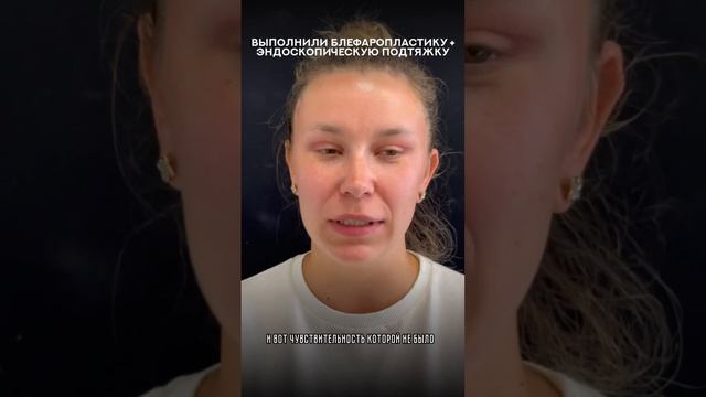 Результат #эндоскопическаяподтяжка #блефаропластика #подтяжкалица #пластическийхирургспб