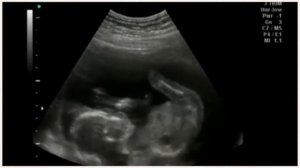 УЗИ на 17 неделе беременности