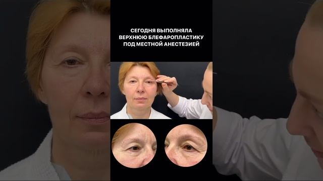 #блефаропластика под местной анестезией. #пластическийхирургспб