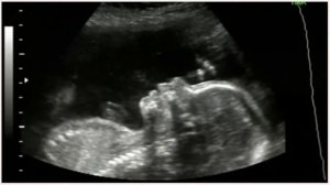 УЗИ на 22 неделе беременности