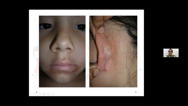 Dermatitis Atópica mas allá del tratamiento farmacológico смотреть онлайн