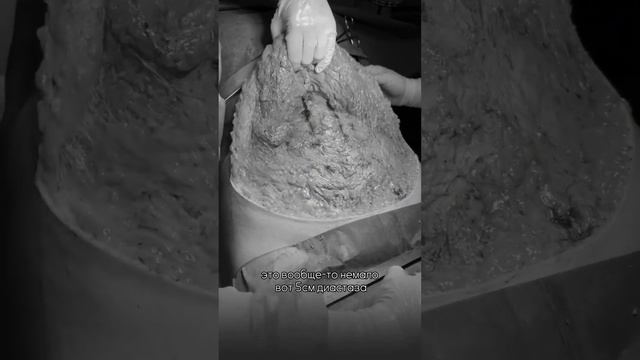 Абдоминопластика