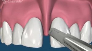 9  Пластика уздечки верхней губы