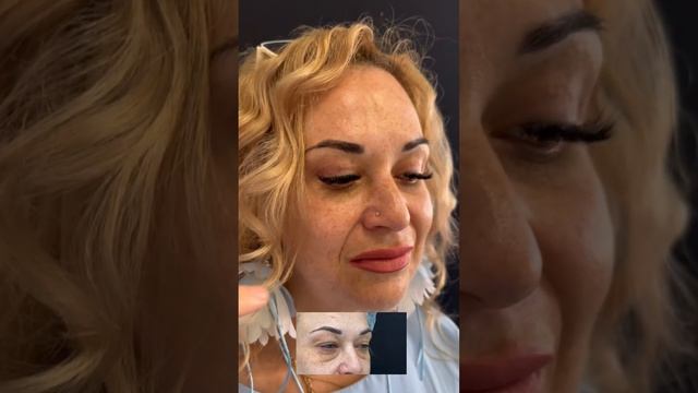 Результат #блефаропластика #верхняяблефаропластика #пластическийхирургспб #нижняяблефаропластика