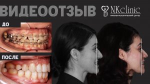 NKclinic - отзывы пациентов. Исправили мезиальный прикус при помощи ортогнатической операции