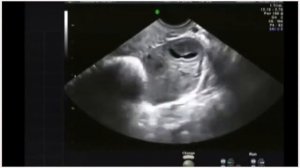 УЗИ на 8 неделе беременности