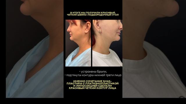 Результат #смасподтяжка и #платизмопластика #подтяжкалица #блефаропластика
