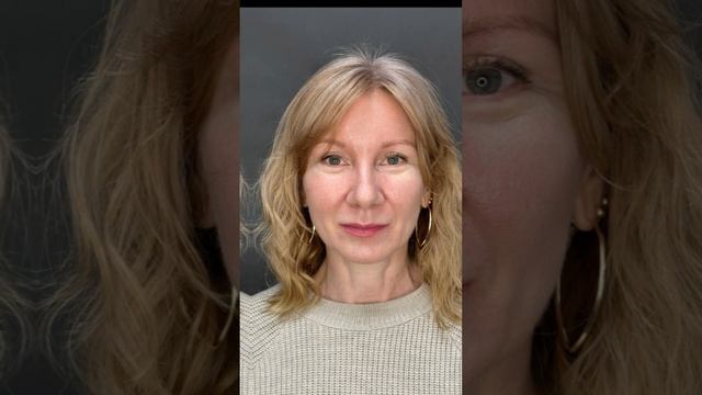 #beforeandafter #блефаропластика #пластическийхирургспб #подтяжкалица