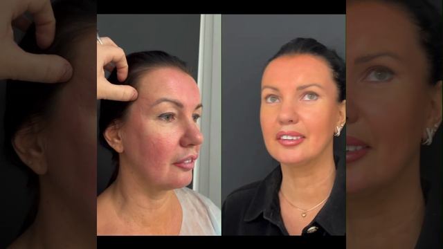 Результат эндоскопической подтяжки и блефаропластики #подтяжкалица #эндоскопическаяподтяжка