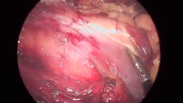 TAPP при хронической боли после ТАРР