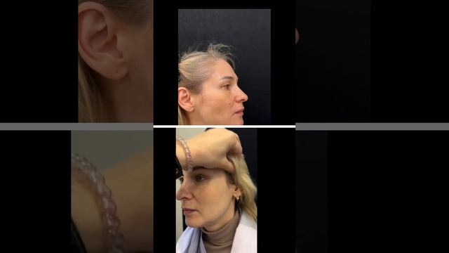 Ранний результат эндоскопической подтяжки #эндоскопия #подтяжкалица #блефаропластика