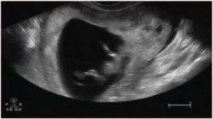 УЗИ на 11 неделе беременности