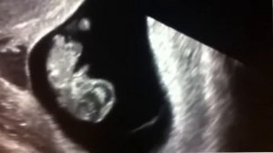 УЗИ на 9 неделе беременности