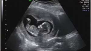 УЗИ на 12 неделе беременности