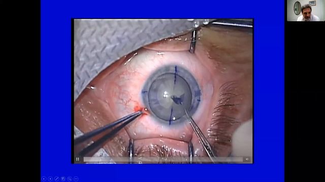 Виды хирургического лечения катаракты смотреть онлайн