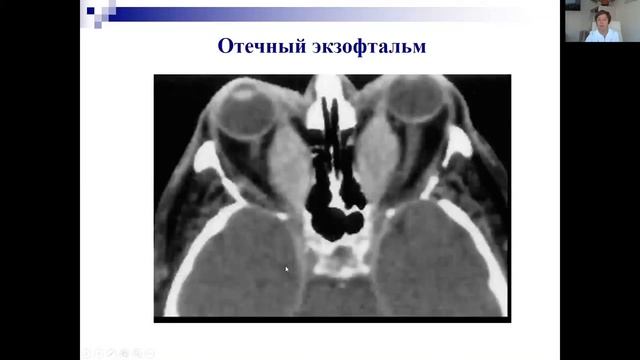 Эндокринная офтальмопатия смотреть онлайн