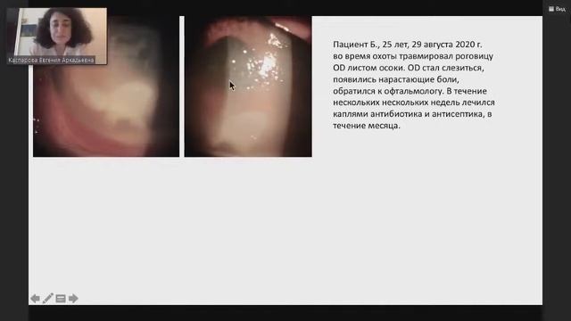 Грибковые поражения глаз. Доклад 4 смотреть онлайн