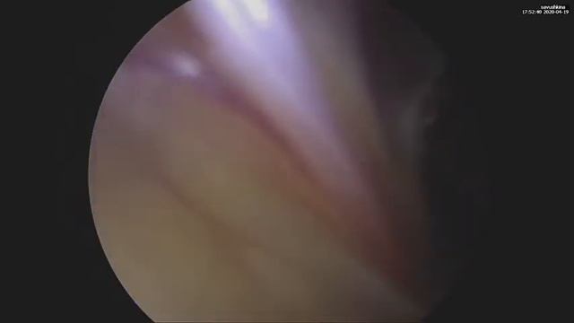 Лапароскопическая герниопластика (ТАРР) при ущемленной паховой грыжи. смотреть онлайн