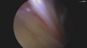 Лапароскопическая герниопластика (ТАРР) при ущемленной паховой грыжи.