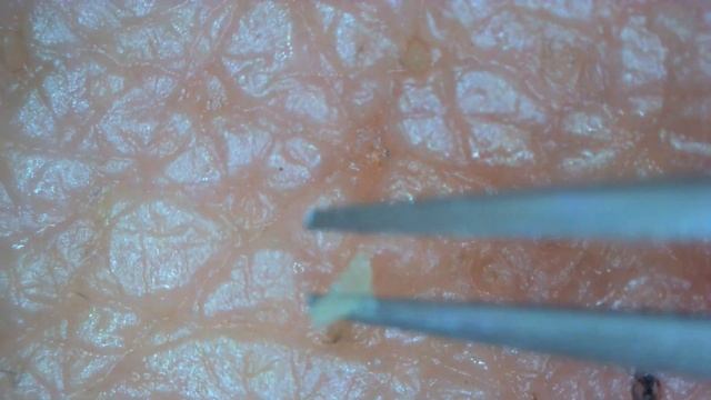 0237 Keratin Plug Removal Chin