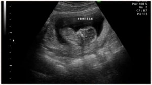 УЗИ на 14 неделе беременности