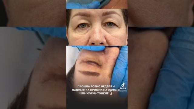 Ранний результат #блефаропластика #beforeandafter #пластическийхирургспб