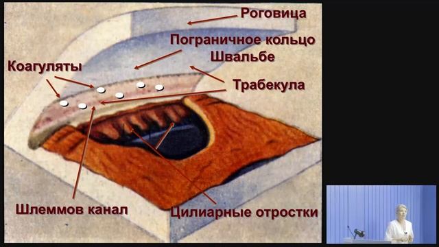 Лазерное лечение глаукомы смотреть онлайн