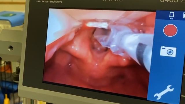 VL intubation with Tritube. Laryngeal papilloma @andreyvarvinskiy4631 смотреть онлайн
