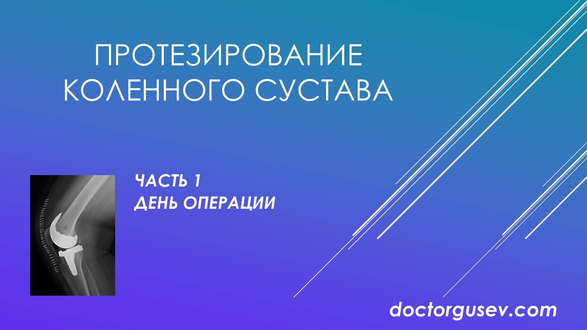 Восстановление и реабилитация после эндопротезирования коленного сустава, часть 1 смотреть онлайн