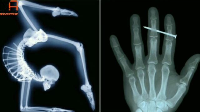 X-Ray क्या है ||कहाँ-कहाँ USE होती है||कैसे बनाते है|| X-Rays!!Side Effect क्या है || Hindi ||2018 смотреть онлайн