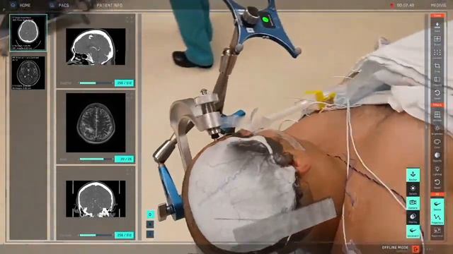 Real-time 3D surgery with Apple Vision Pro 🔇 смотреть онлайн