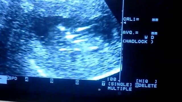 12 week ultrasound - FTP's Shocked at first Ultrasound смотреть онлайн