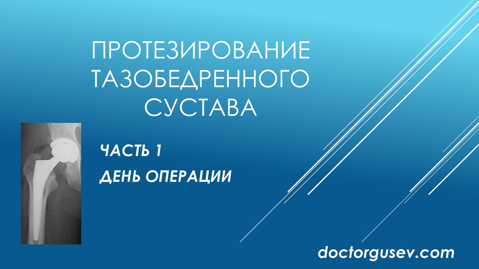 Восстановление и реабилитация после эндопротезирования тазобедренного сустава, часть 1 смотреть онлайн