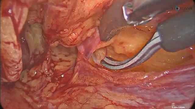 Reparación preperitoneal de eventración suprapúbica y hernia crural derecha recidivada смотреть онлайн