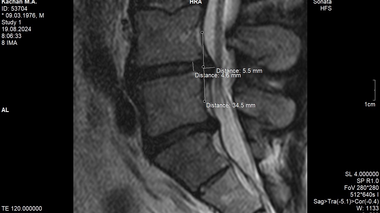 Уменьшили грыжу за неделю на 1мм