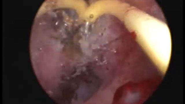 Гістрорезектоскопія Перинатальний центр