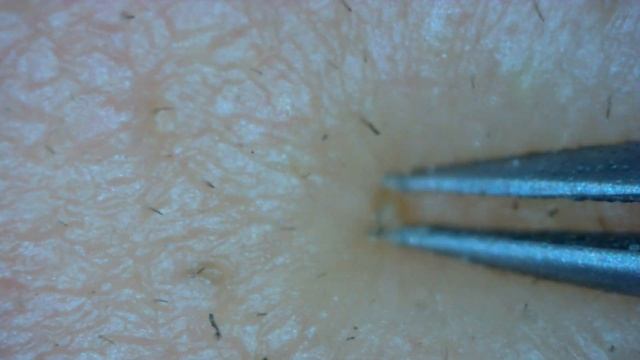 0240 Keratin Plug Removal Nose