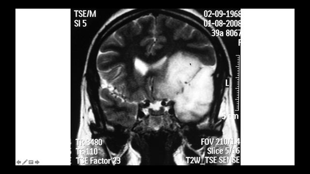 TUMORES INTRACRANEALES para Estudiantes (Dr. Alvaro Campero) смотреть онлайн
