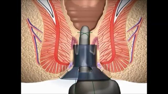 Stapled Haemorrhoidectomy using the PPH System - English смотреть онлайн