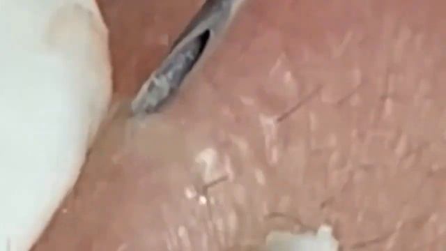 Огромные прыщи. Удаление и выдавливание черных точек. Чистим лицо.