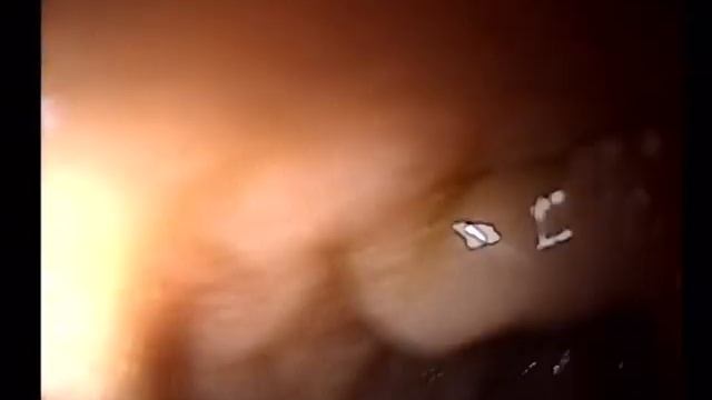 Эритематозная гастропатия с дуоденогастральным рефлюксом