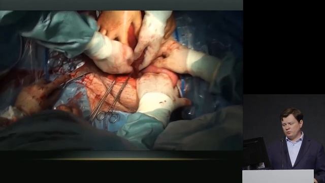 Как делают кесарево ужас операция. Про гинекологию. Говорят врачи. Лекция 4 смотреть онлайн